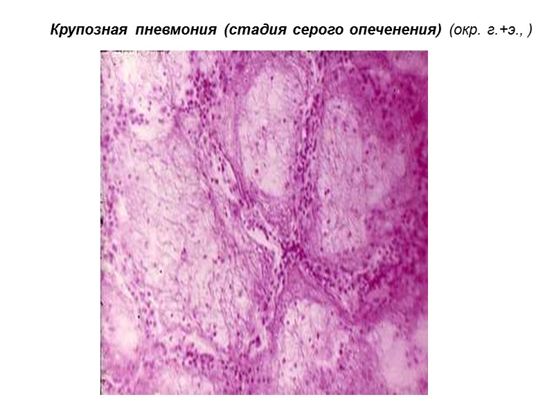Крупозная пневмония (стадия серого опеченения) (окр. г.+э., )